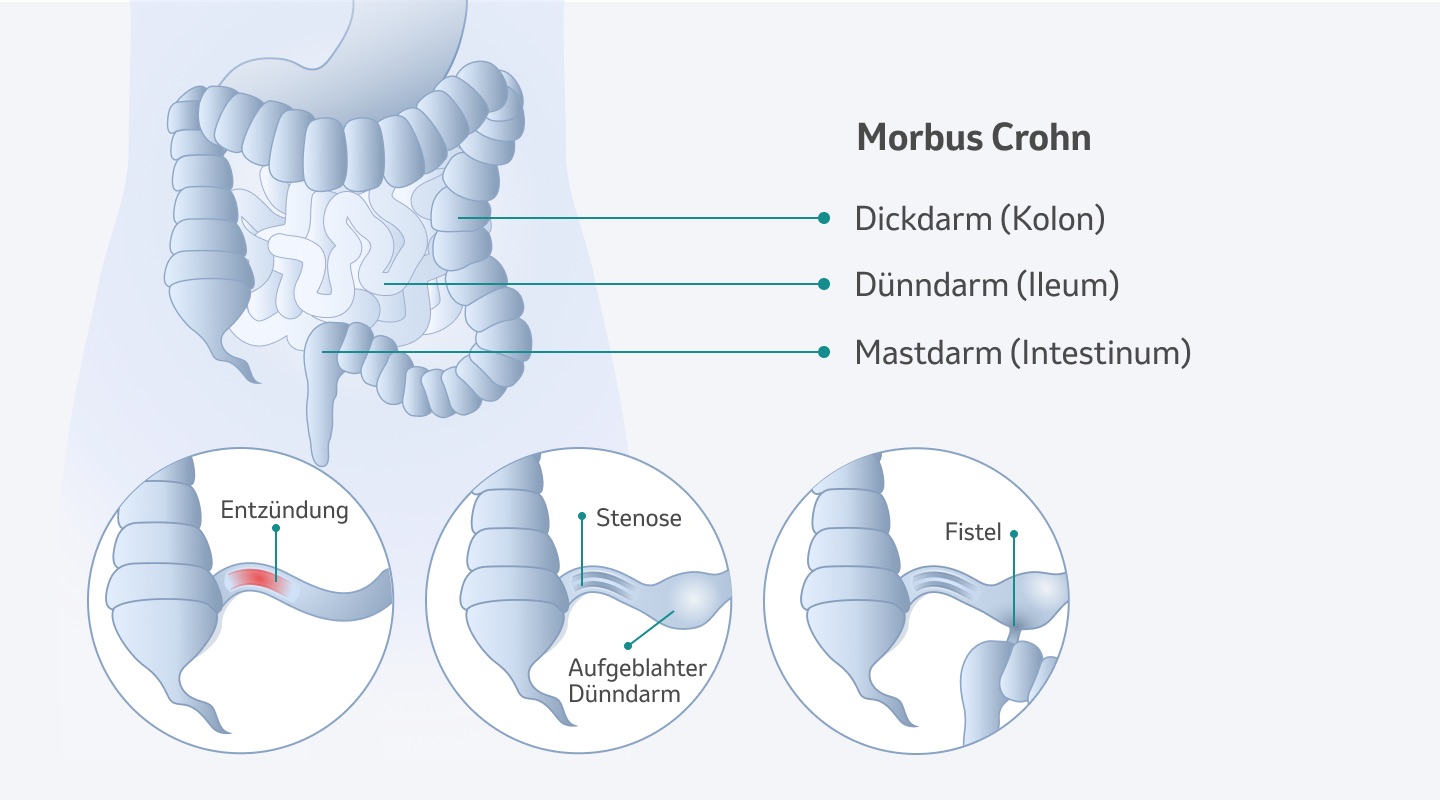 Morbus Crohn Definition MSDGesundheit Schweiz
